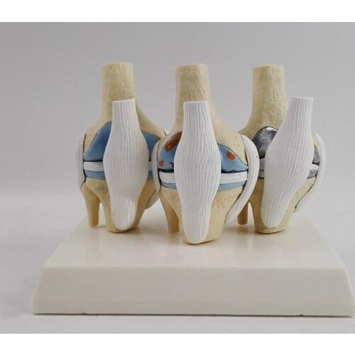 Knee joint model meniscus cruciate ligament knee skeletal bone pathological joint ligament
