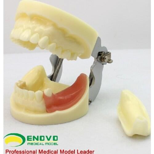 Oral implantation model of dental surgery teaching model