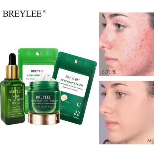 BREYLEE Acne Treatment Set 3pcs Acne Pimple Patch Acne Treatment Serum Cream Pimple Scar Remover Moisturizing Facial Skin Care