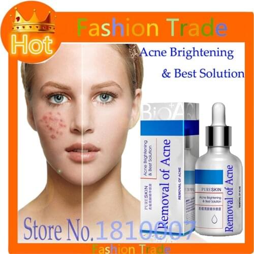 30ml Blackhead Mite Treatment anti melasma & Freckle cream Acne Scars Remove Whitening Moisturizing herbal medicine oil control