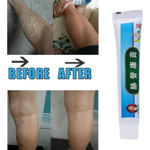 10pcs/lot Chinese natural herbal medicine for treating varicose vascular inflammation cream cure varicose vein ointment