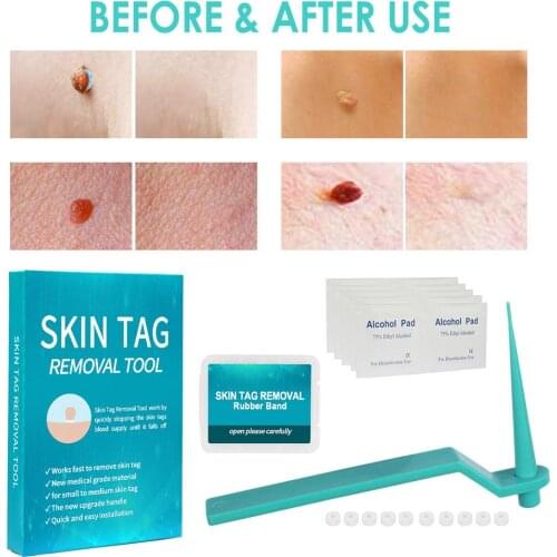 Micro Band Non Toxic Face Care Mole Wart Tool For Blue Skin Tag Removal Kit With Cleansing Swabs Rubber Ring Home Use