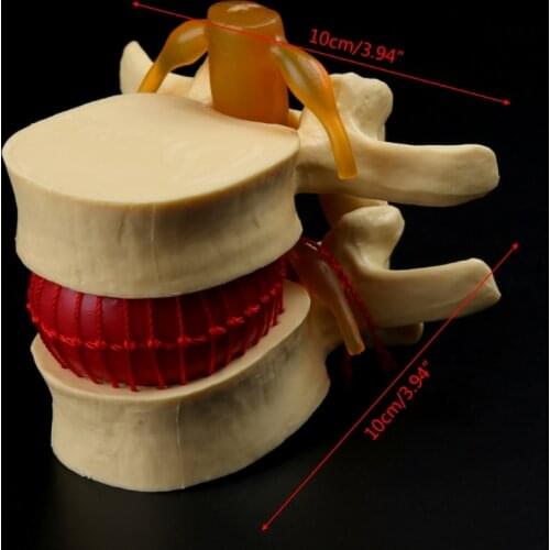 B2RC Anatomical Spine Lumbar Disc Herniation Anatomy Teaching Tool