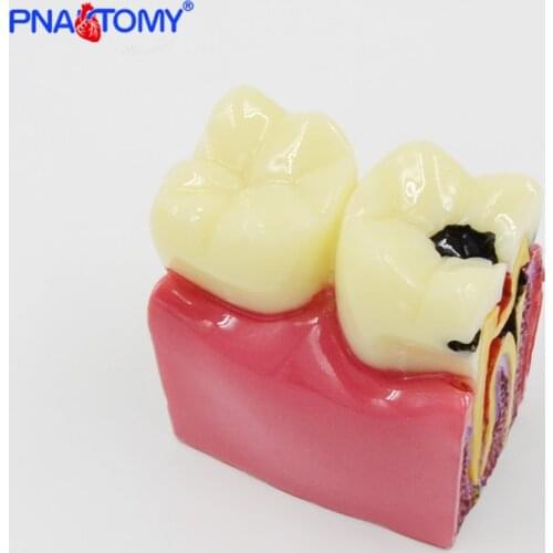 Dental Materials Lab Teeth Model 6 Times Caries Comparation Study Models For Dentist Studying and Researching
