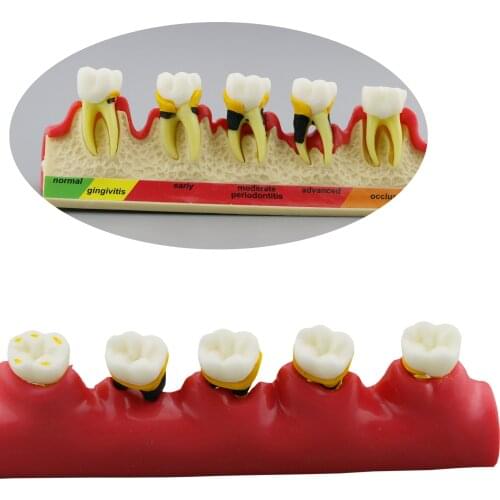 Dental Periodontal Disease Demonstrate Model Typodont Teeth Model Periodontics (PER) 4010