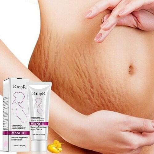 Mango Remove Pregnancy Scars Acne Cream Stretch Marks Scar Skin Treatment C3Y0