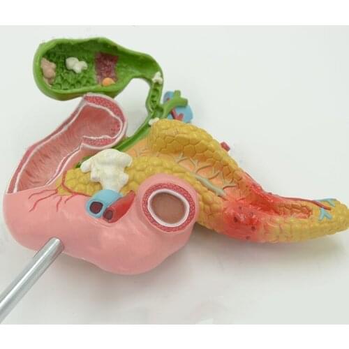 Anatomical model of pathological structure of pancreas, duodenum and gallbladder in medical human body Surgery of internal