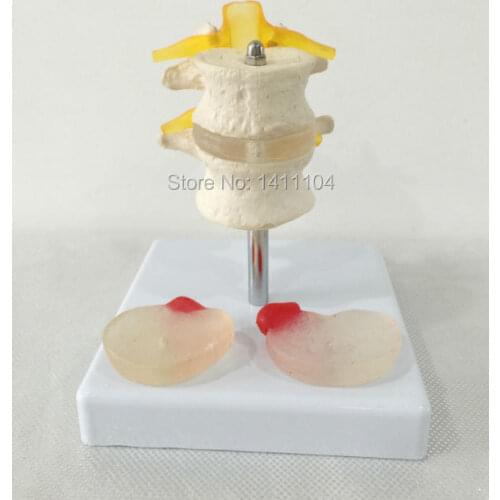 Free shipping office&2 lumbar vertebrae with 2 lesions of intervertebral disc, human skeletal model, human model