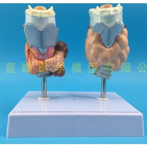 Human thyroid pathology model Hyperthyroidism model Morbid medical anatomy of endocrine system