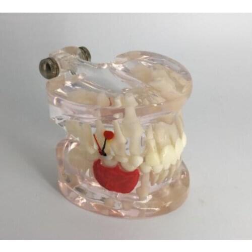 Tooth model Early morbid dental model for childrens teeth transparent Teaching demonstration
