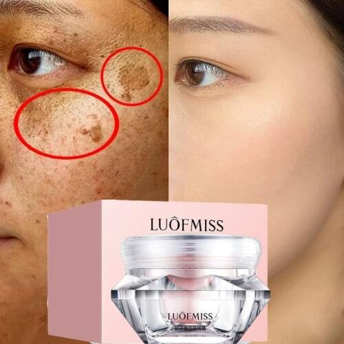 Effective Whitening Freckle Cream Remove Melasma Acne Spot Pigment Melanin Dark Spots Pigmentation Skin Whitening Cream