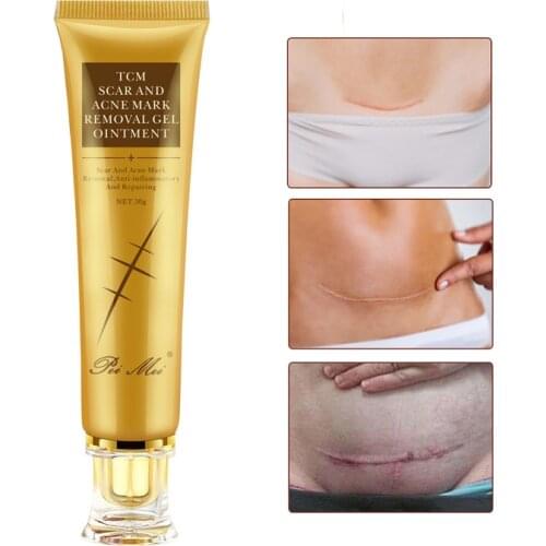 Removal Scar Cream Face Pimples Scar Stretch Marks Removal Acne Treatment Whitening Moisturizing Cream Skin Care