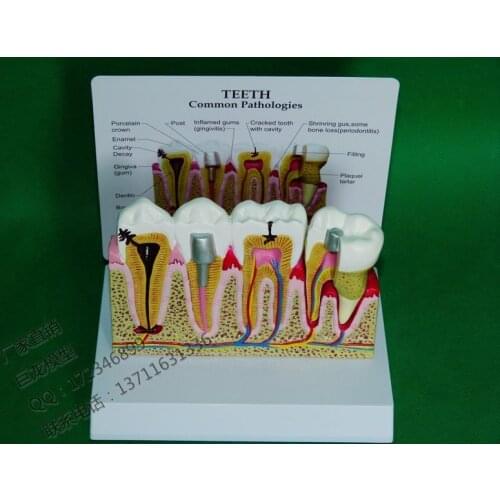 Mix model , mannequin ,tooth model teeth common pathologies model