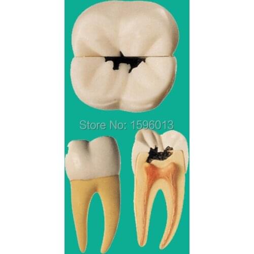 Dental Caries Model, decayed teeth model