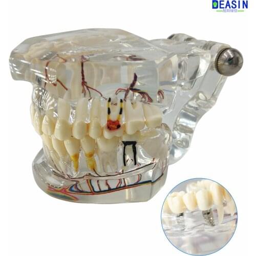 High quality dental teeth model Transparent pathological implant nerve model Repair model Teaching demonstration model
