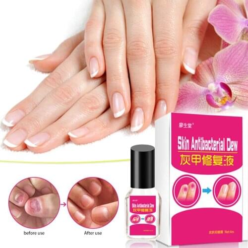 Kills Bacteria Nail Fungal Treatment Anti Nail Fungus Infection oil Onychomycosis Paronychia Removal Nail Care Repair Liquid 4ML