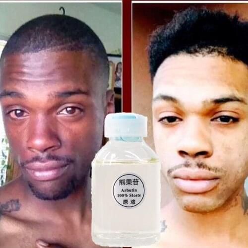 30Ml 100% Alpha Arbutin Skin Super Whitening Dark Lightening Brightening Serum Kojic Acid Serum Bleaching Cream Face Beauty