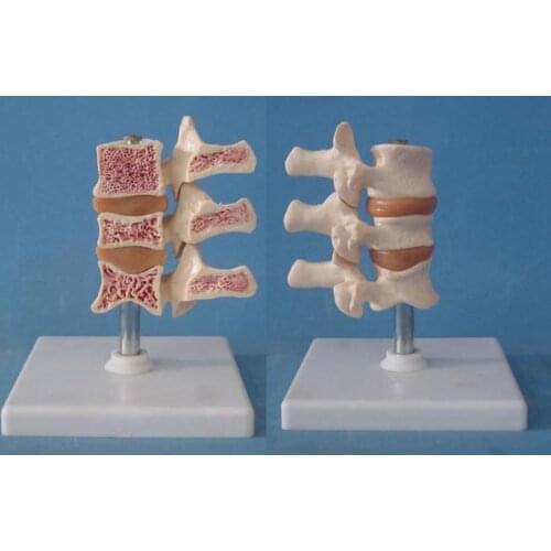 Human Osteoporosis health Bone and Morbid state Bone Compare model Spine Medical Teaching free shipping