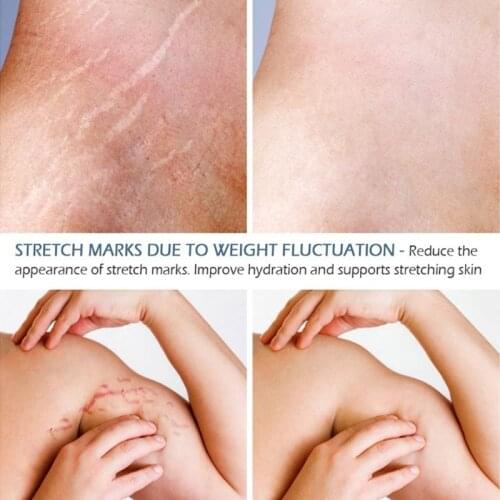 2021 New 20g Natural Herbal Extract Scar Cream Stretch Marks Remover Skin Repair Facial Acne Spots Treatment Whitening Ointment