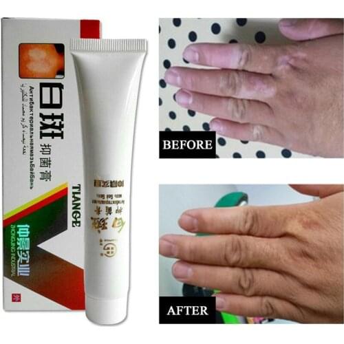Medical White Spot Disease Cream Pigment Melanin Promoting Liniment Skin Vitiligo Leukoplakia Disease Treatment plaster