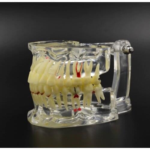 High Quality Dental Implant Disease Tooth Pathological Extrusion Missing With impacted tooth dental pathological teeth implant