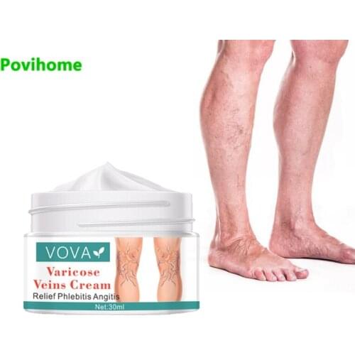 30ml Treatment Varicose Veins Cream Varicosity Angiitis Ointment Relief Veins Pain Phlebitis Medical Plaster Health Care