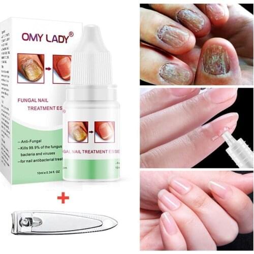 10ml Anti Fungal Treatment Nail Nail Fungus Treatment Care Paronychia Toe Infection Nails For Onychomycosis Finger Herbal Q8M2