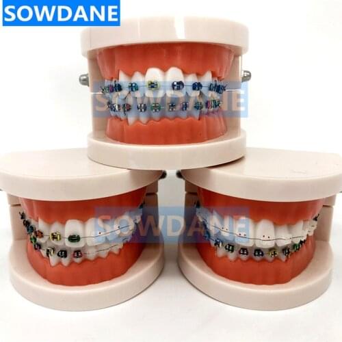 Dental Orthodontic Typodont Model With Ortho Metal Brackets Ceramic Bracket Arch Wire Buccal Tube Ligature Ties Teaching Model