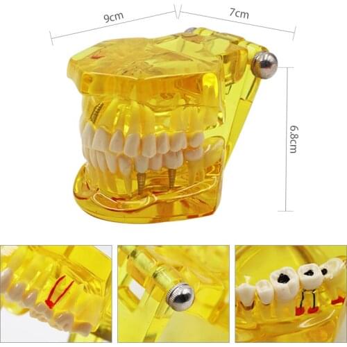 1pc Dental Teeth Model Oral Teeth Teaching Model Dental Teeth Disease Implantation Model Detachable Training Tools Equipment