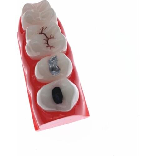 Dental Study Model for Pit and Fissure Sealing Treatment Teeth Model 2018