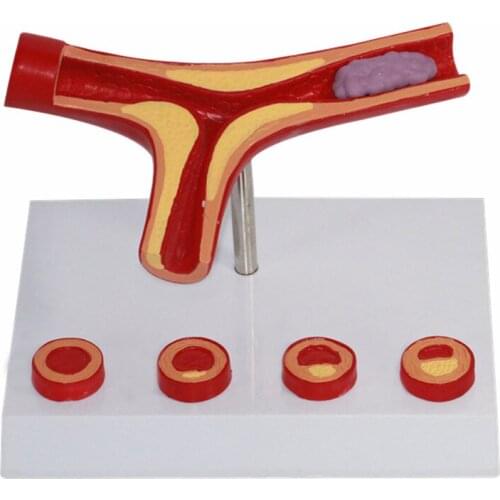 Vascular model atherosclerosis model vascular occlusion thrombus model