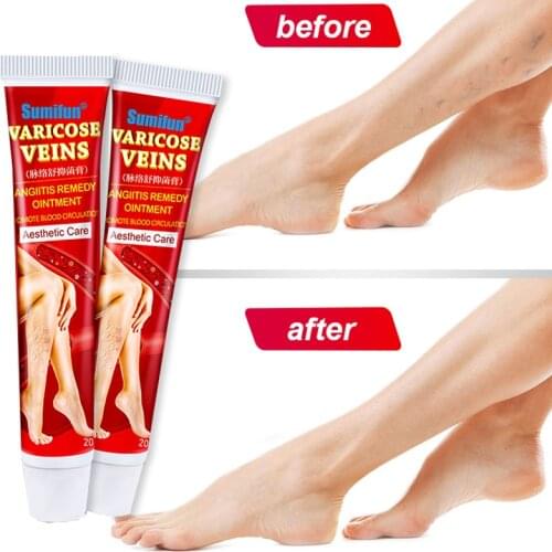 Varicose Veins Treatment Cream Ointment Vasculitis Phlebitis Spider Veins Pain Varicosity Angiitis Remedy Removal Herbal Cream