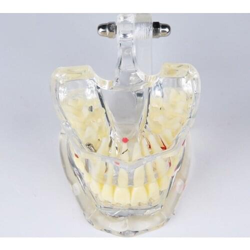Dental Implant Disease Teeth Model M4001/Dental Study Tooth Transparent Adult Pathological Teeth Model/ Implant Disease Model
