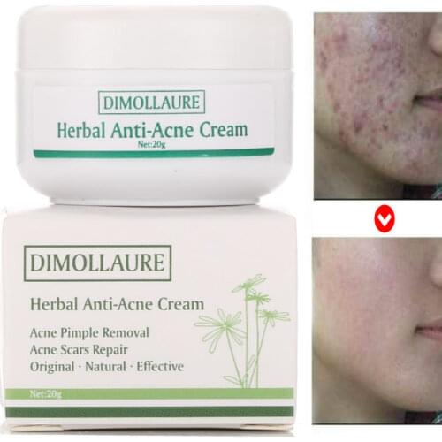Dimollaure Anti-acne cream Face cream acne treatment Comedone Pimple Acne Scar Blackhead Removal Oil control Skin care whitening