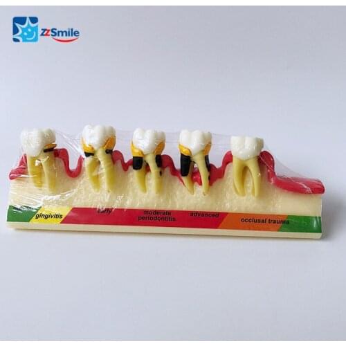 M4010 Periodontal Disease Model/Dental Model