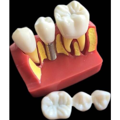 1 PC 4-times Implant Disease Teeth Model Oral Teaching Model Dental Pathology Model