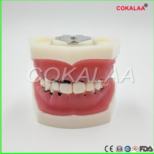 Free shipping Dental Periodontal Disease Model / Medical and teaching teeth Model