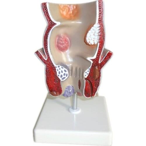 Medical Human Rectal Pathological Hemorrhoids Demonstration Model