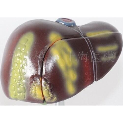 Liver model liver pathology model fatty liver cirrhosis liver carcinoma model hepatobiliary disease model