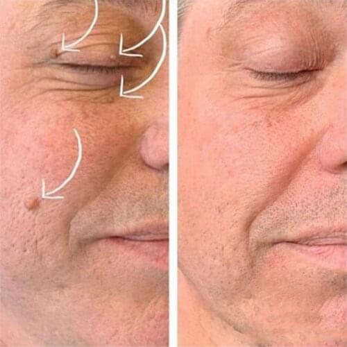 Ultra Strength Natural Health Mole Nevus Wart Skin Removal Treatment Warts Tag Tag Skin Foot Corn Y6R1