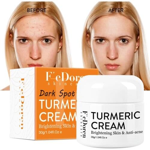 Herb Turmeric Face Cream Repair Acnes Scar Dark Spot Treatment Moisturizer Whitening Lightening Against Acne Skin Care 30ml