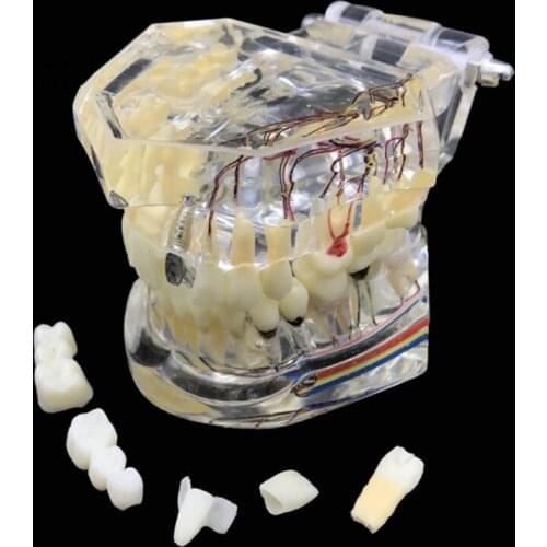 Dental Restoration Teeth Model with Teeth Nerve Detachable Tooth Disease Teaching Model Transparent Implant Disease Teeth Model