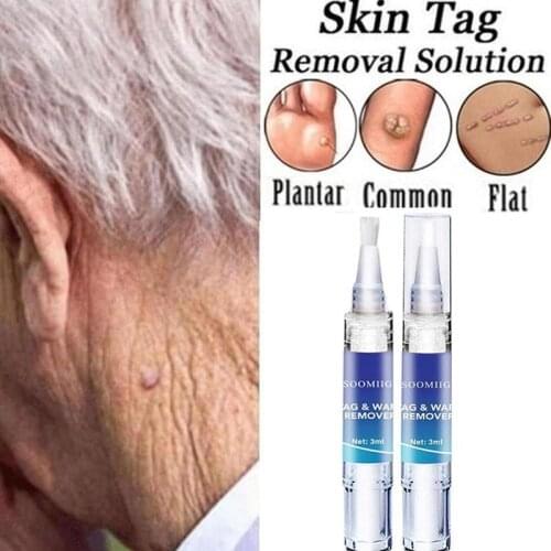 3ml Skin Tag Remover 1pc Natural Health Mole Nevus Wart Skin Tag Foot Corn Warts Treatment Skin Tag Removal