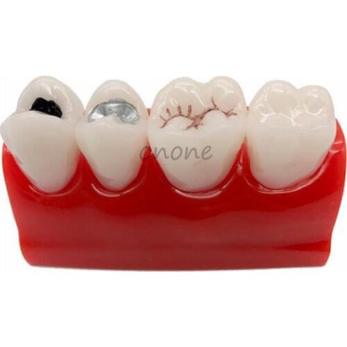 1pcs Pit and Fissure Closure Model Early Dental Caries Model Student Learning Teaching Model