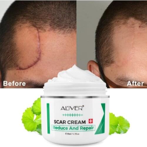 Advanced Treatment For Face & Body Old & New Scars From Cuts,Stretch Marks,C-Sections & Surgeries Skin Care Scar Removal Cream