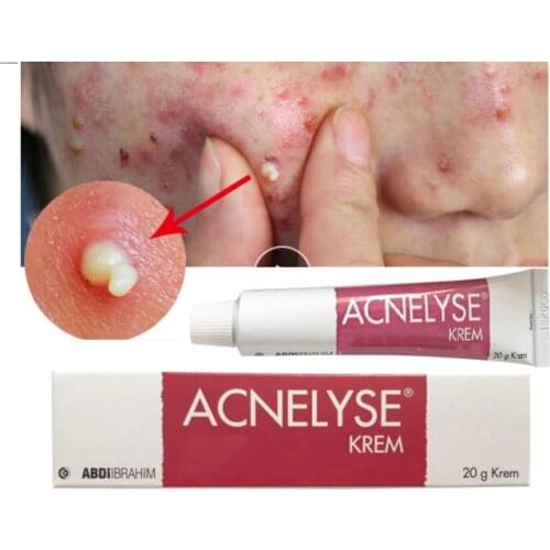 Acne tretin sivilce yara izi temizleme kremi sivilce streç yüz jel kaldırmak akne pürüzsüzleştirici beyazlatıcı nemlendirici