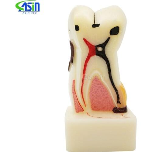Four times size dental pathology teeth model, dental caries, calculus, pulp stones, Occlusal tooth wear