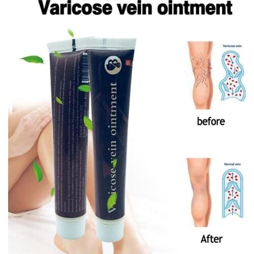 New Varicose Veins Miracle Cream Treatment Effective cure Vasculitis Phlebitis Spider Veins Pain Varicosity Angiitis Ointment