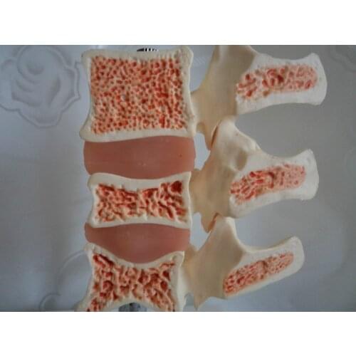 Osteoporosis Model Spine Pathological Model Human Spine Model Human Anatomy Skeleton Vertebrae Disease Medical Teaching Supply