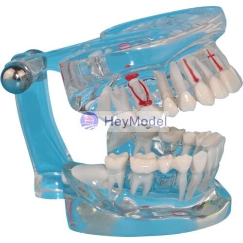 HeyModel Human Teeth with Pathology